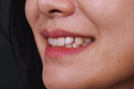 당신이 서울 교대역 재주좋은치과 라미네이트로 치료해야 하는 이유 관련 이미지 3