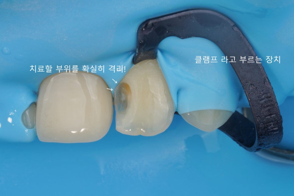 서초동 앞니 사이 충치, 기존 레진 제거 후 다시 치료 했습니다. 관련 이미지 2