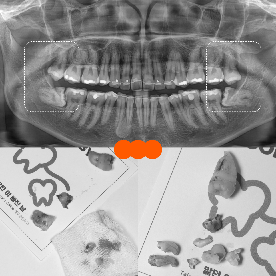 사랑니발치 매복 돼도 이렇게 빼면 안전해요 관련 이미지 15
