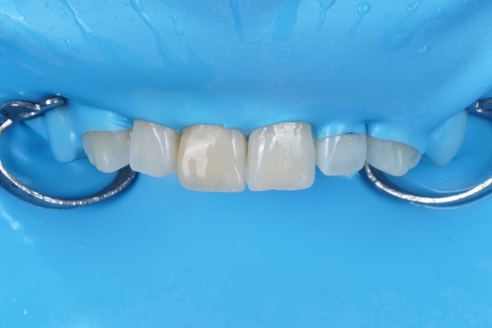 앞니 레진이 깨졌을 때, 재치료 잘하는 서초 치과 관련 이미지 4