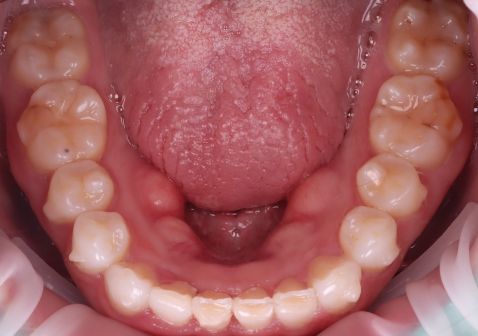 신사역치과 미국에서 교정 중이던 분 앞니 레진으로 고민 해결 관련 이미지 8