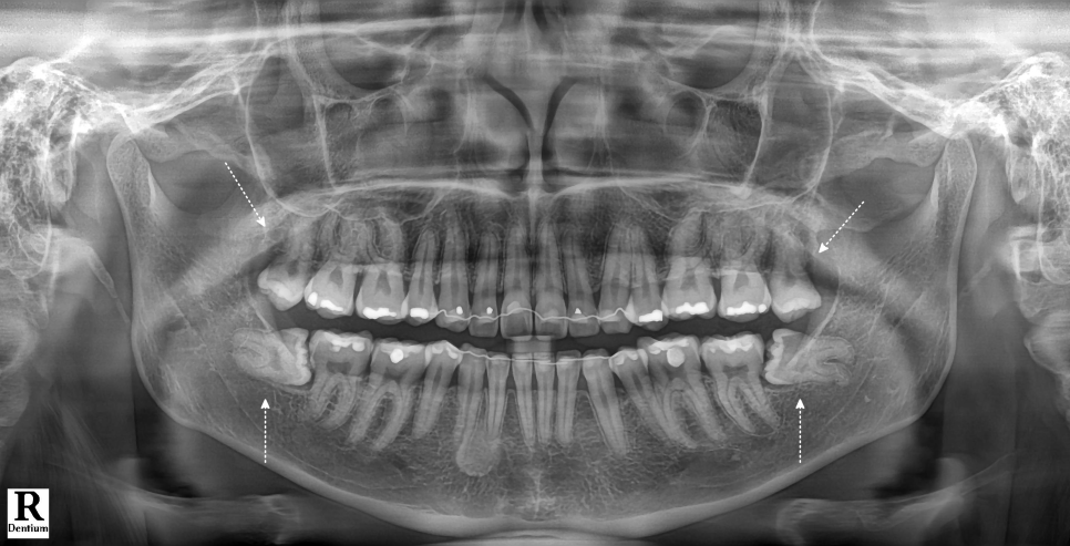 사랑니발치 매복 돼도 이렇게 빼면 안전해요 관련 이미지 5