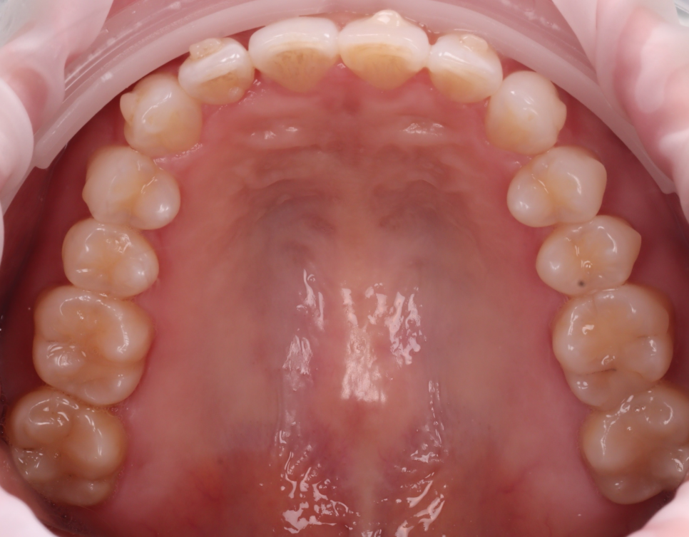 신사역치과 미국에서 교정 중이던 분 앞니 레진으로 고민 해결 관련 이미지 7