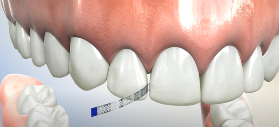 서초구치과 치아 사이 삭제 부작용과 치료법 관련 이미지 3