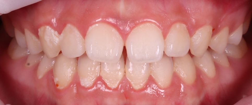 방배동치과 앞니 벌어짐 해결하러 강릉에서 오셨어요 관련 이미지 5