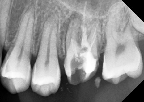 신경치료 후 크라운 씌운 치아 통증, 재신경치료 및 지르코니아 크라운 재치료 관련 이미지 2