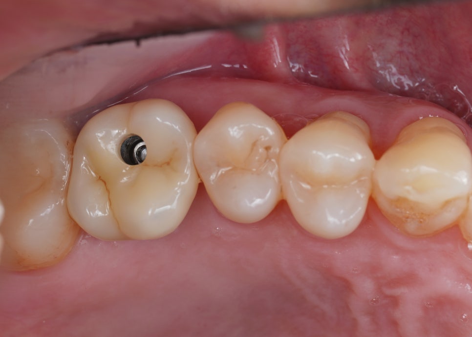 임플란트 구멍, 레진 빌드업으로 메우기 관련 이미지 2