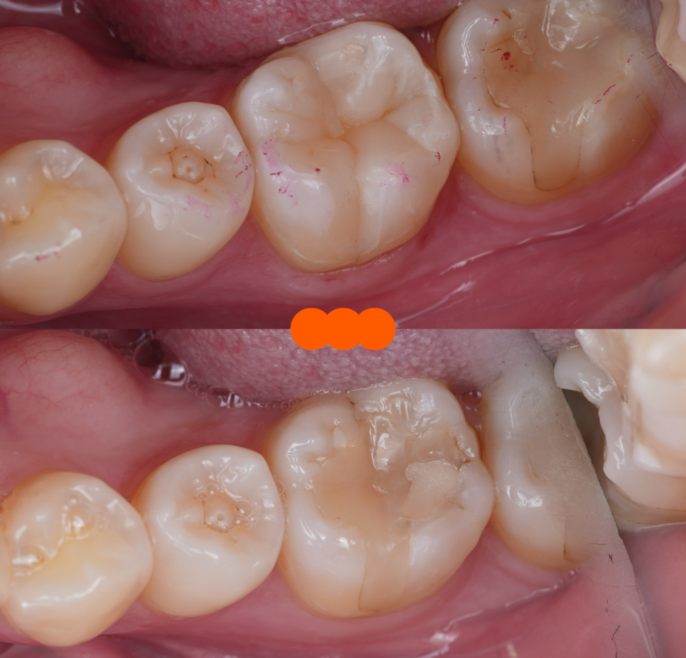 인레이치료 하방 2차 충치 레진 빌드업 사례 관련 이미지 18