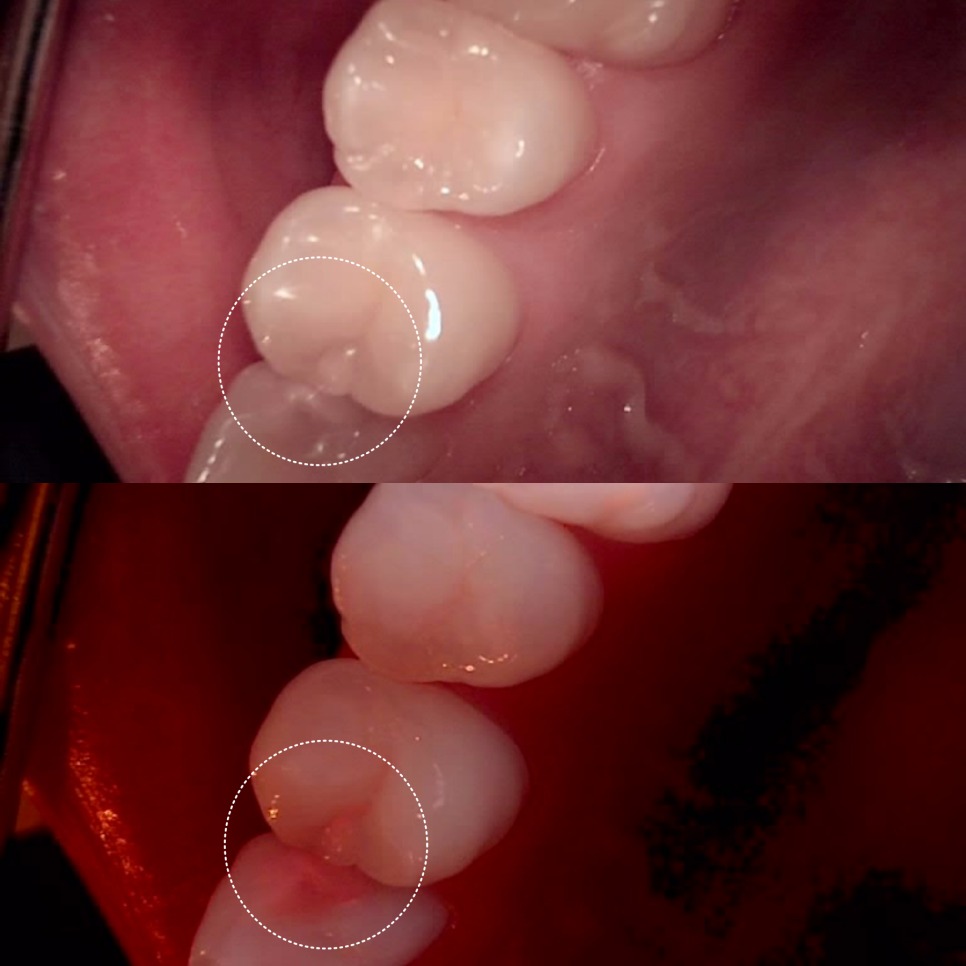 역삼역 치과 치대생 깊은 충치 신경치료없이 레진으로 완료 관련 이미지 7