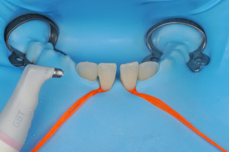 앞니 벌어짐 레진 당일 치료, 앞니 레진 잘하는 서초동 치과 관련 이미지 6