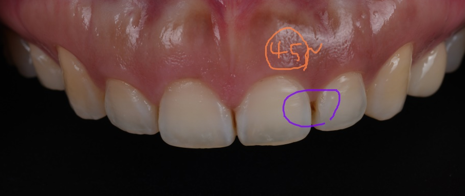 서초구치과 치아 사이 삭제 부작용과 치료법 관련 이미지 8