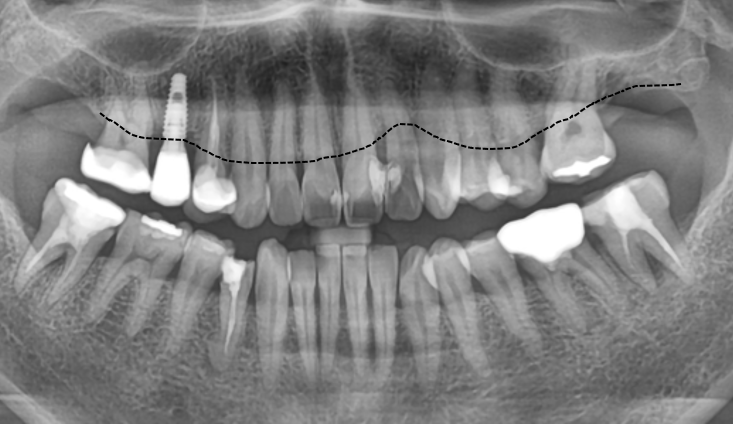 잘못된 앞니 레진 뼈까지 녹인다? 레진 재치료 과정 관련 이미지 4