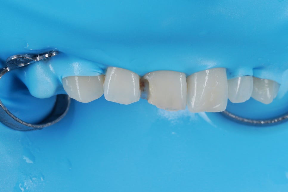 앞니 레진이 깨졌을 때, 재치료 잘하는 서초 치과 관련 이미지 3