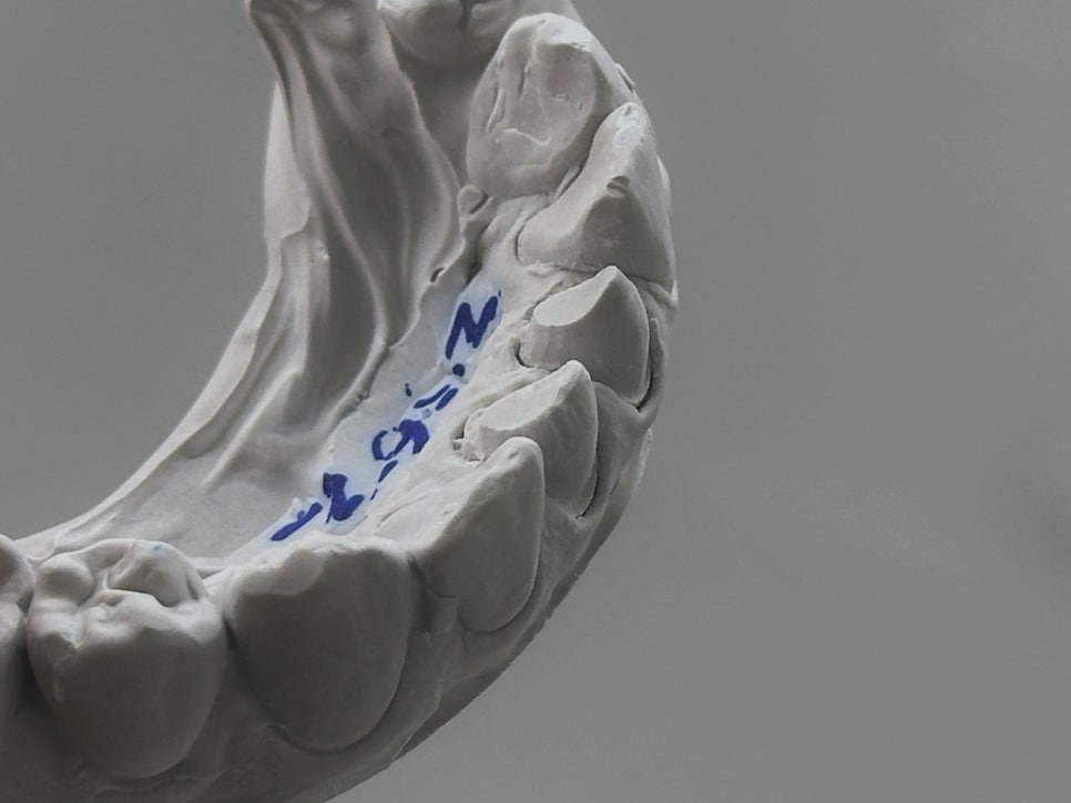 교대역 앞니 신경치료 후 지르코니아 크라운 치과 관련 이미지 4