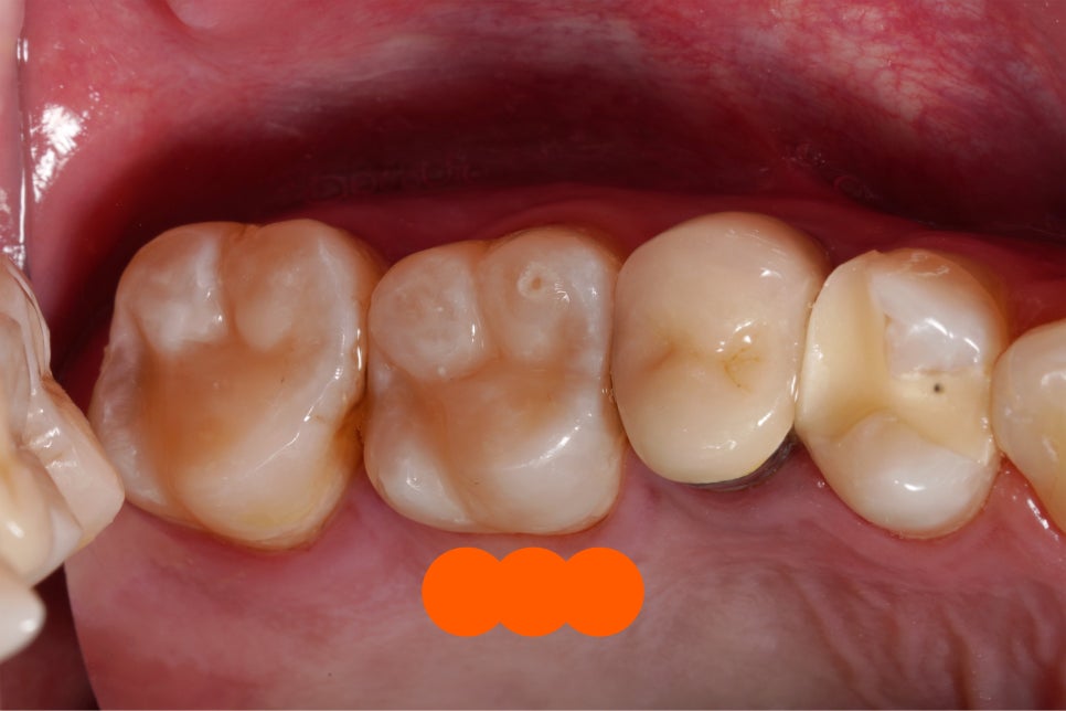 교대역 레진 실란트 밑에 깊은 2차충치 레진빌드업으로 당일 재치료 관련 이미지 6