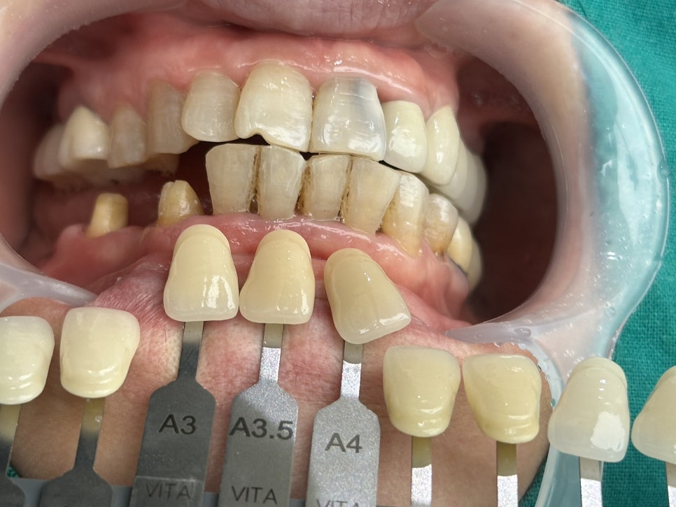 교대역 앞니 임플란트 후기, 자연스러운 지르코니아 크라운 관련 이미지 2
