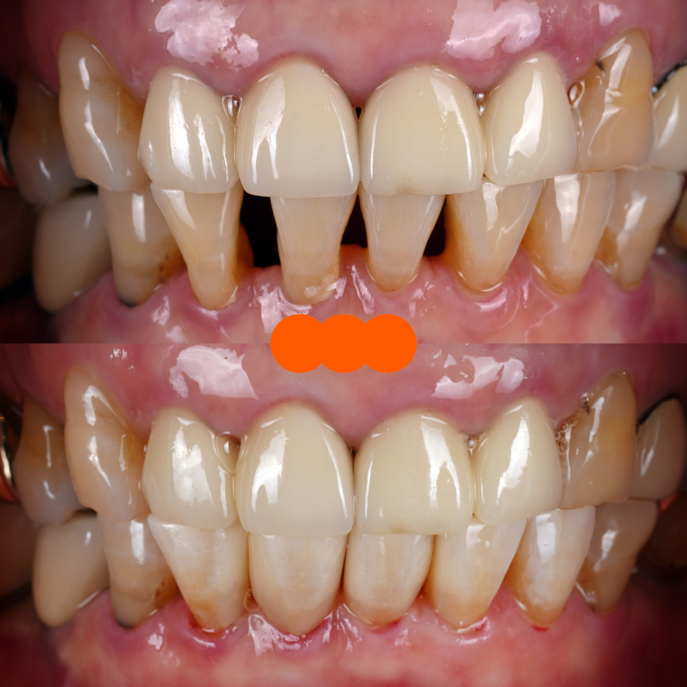 앞니 크라운 재치료 시니어에게 더 중요한 이유 관련 이미지 8