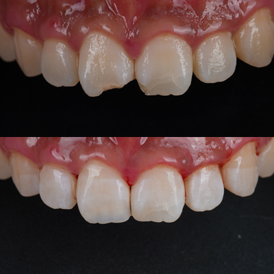반포동치과 앞니 깨짐 레진 삭제 없이 당일에 치료 끝 관련 이미지 11