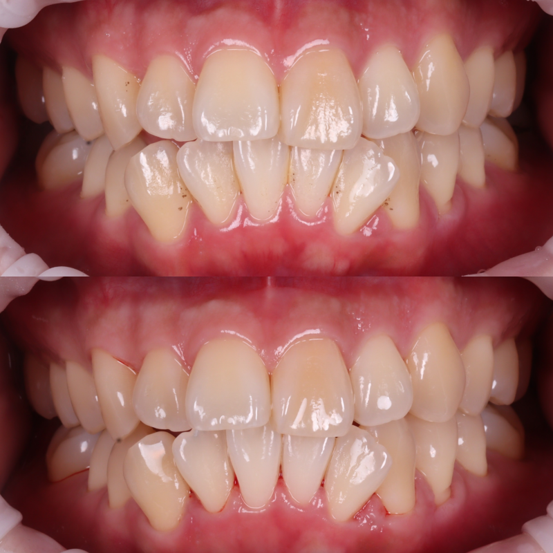 서초동치과 착색 고민되면 에어플로우 하세요 관련 이미지 10