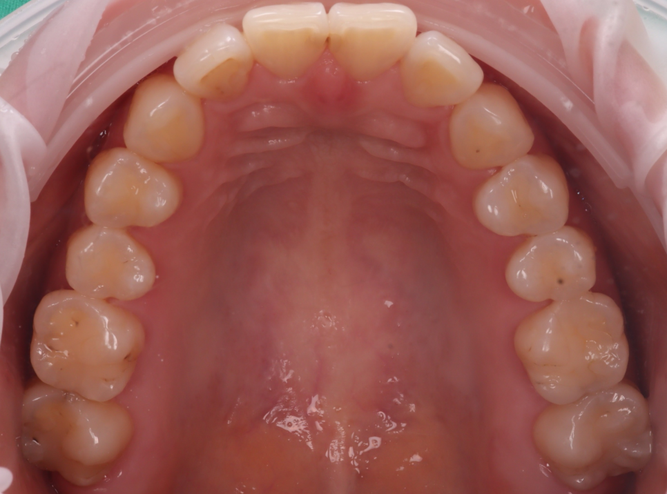 교대역 치과 보철 아래 2차 충치를 다시 레진으로 관련 이미지 3
