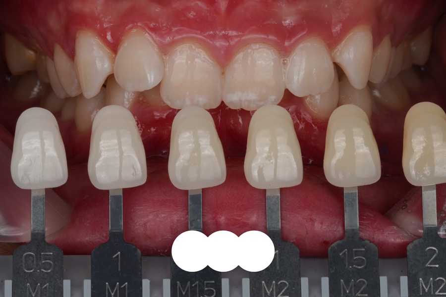 서초 원데이 치아미백은 교대역 재주좋은치과의원이 좋은 EU 관련 이미지 4