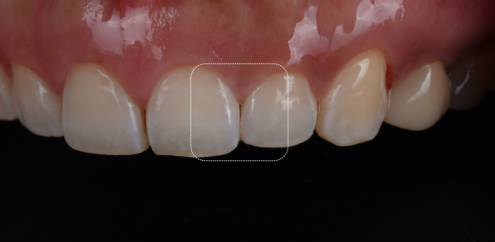 서초구치과 치아 사이 삭제 부작용과 치료법 관련 이미지 14