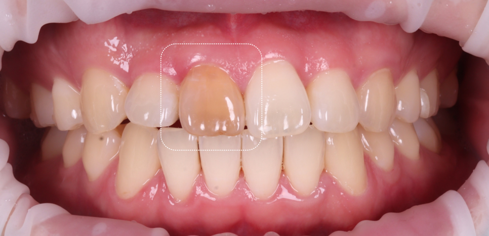 서초치과 5년간 14개 치과 돌다 본원에서 정착한 이유는? 관련 이미지 2
