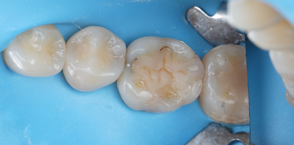 교대역 치과 보철 아래 2차 충치를 다시 레진으로 관련 이미지 24