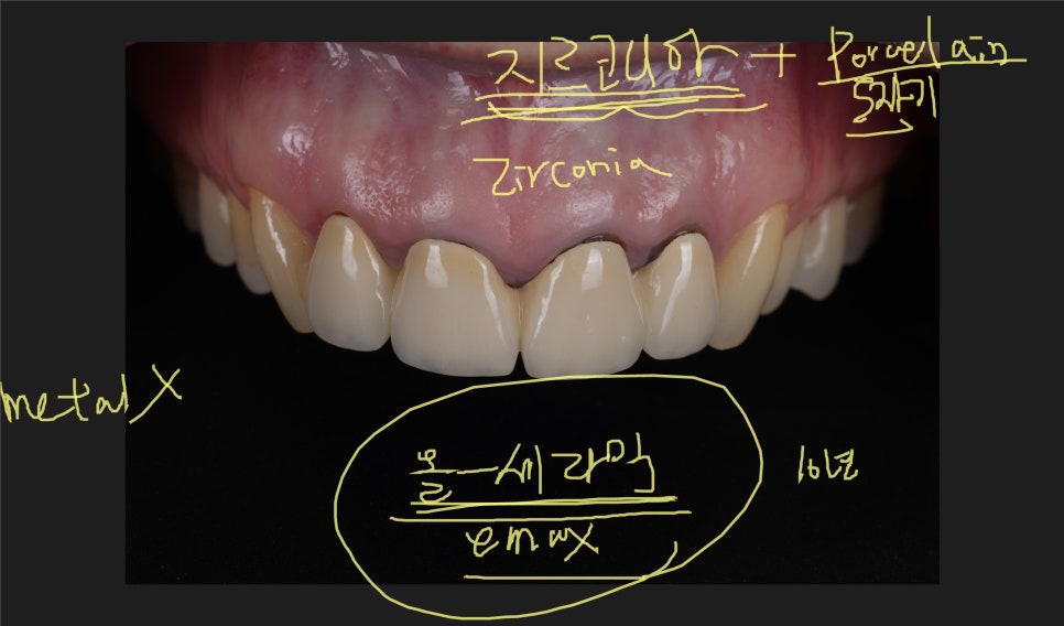 신논현치과 외국인 까만 앞니 크라운 교체 사례 관련 이미지 12