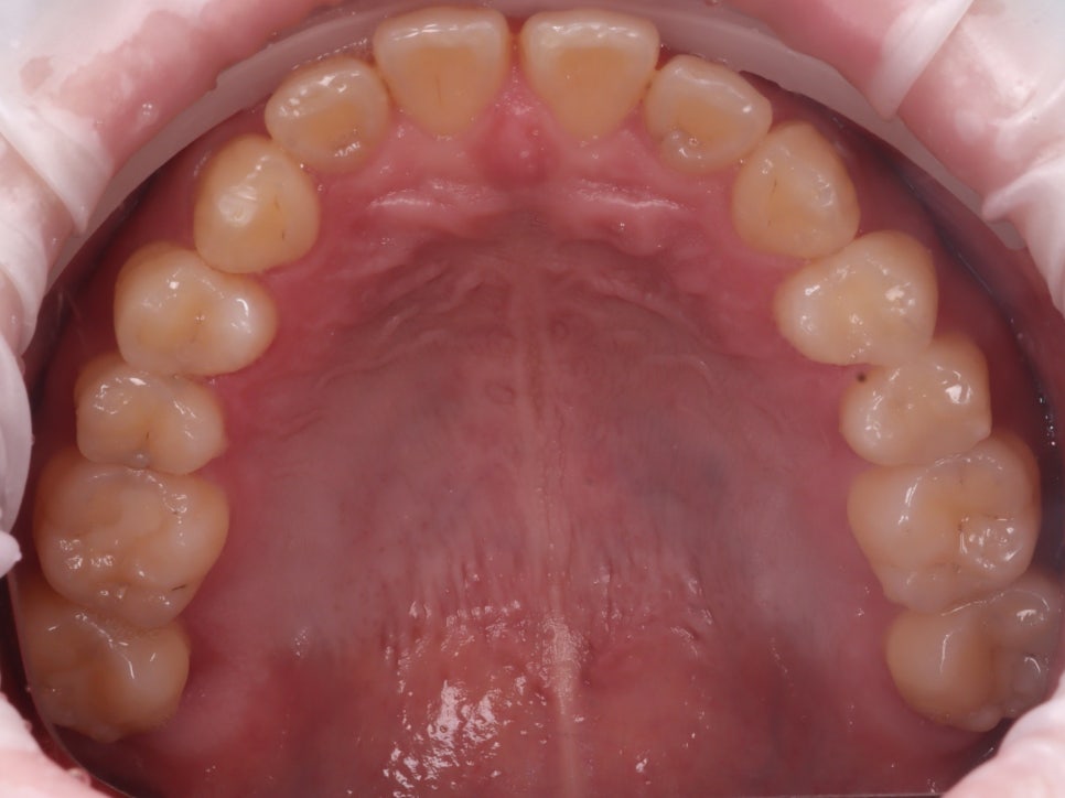 방배동치과 누렇고 벌어진 치아 미백과 레진 치료 관련 이미지 3