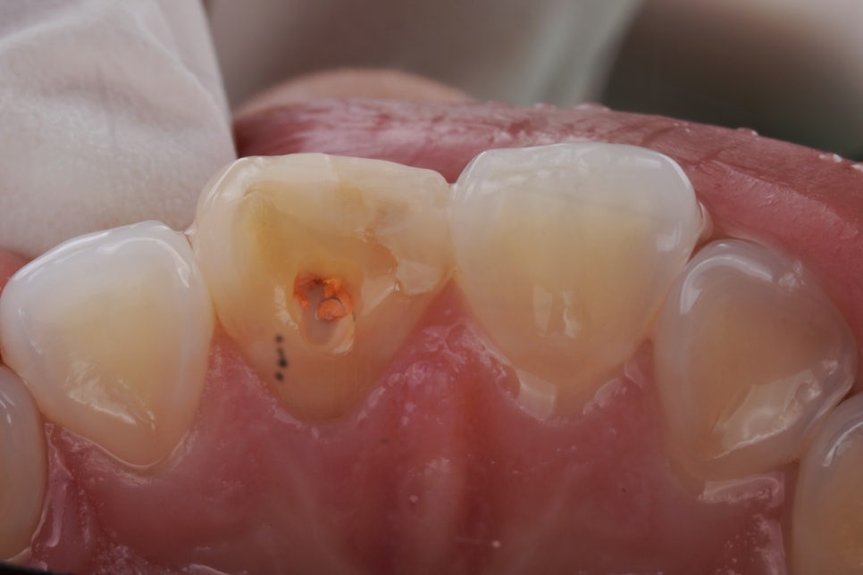 앞니 신경치료 변색 원인과 치료법인 실활치 미백 관련 이미지 4