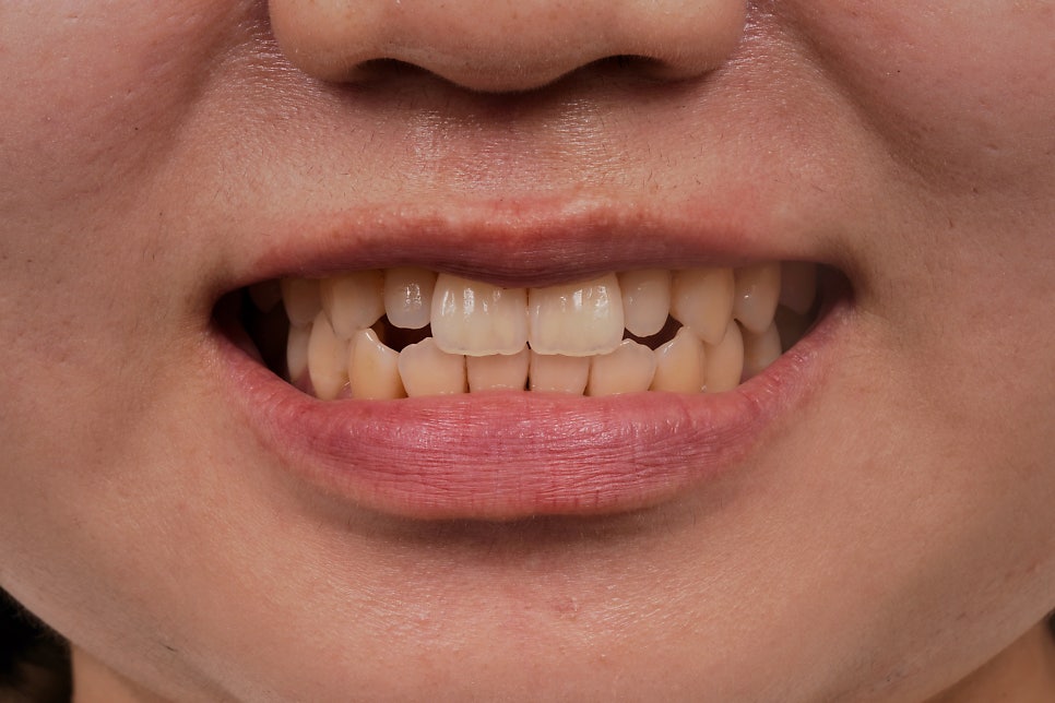 왜소치 레진, 갤럭시네이트 레진비니어로 당일 치료완료 (서초동 치과) 관련 이미지 4