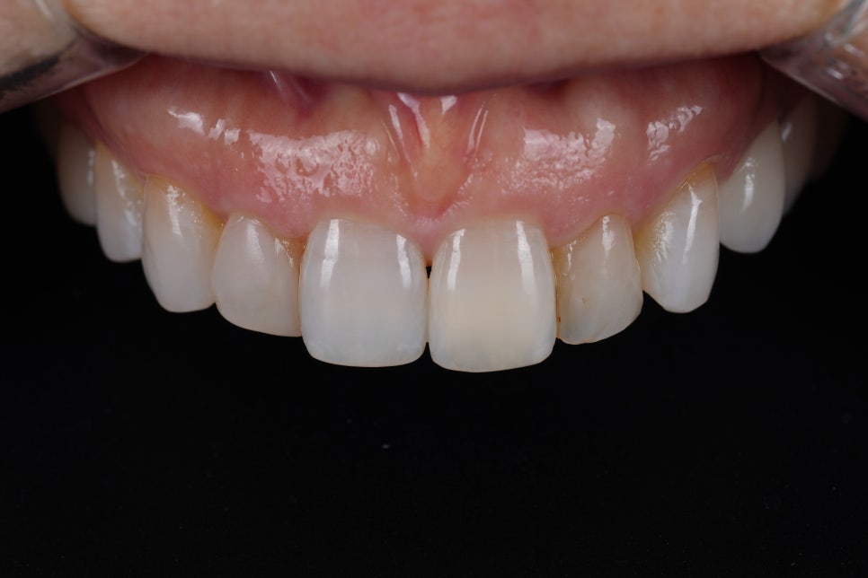 앞니 레진 라미네이트, 1시간 원데이 치료가 가능한 교대 치과 관련 이미지 1