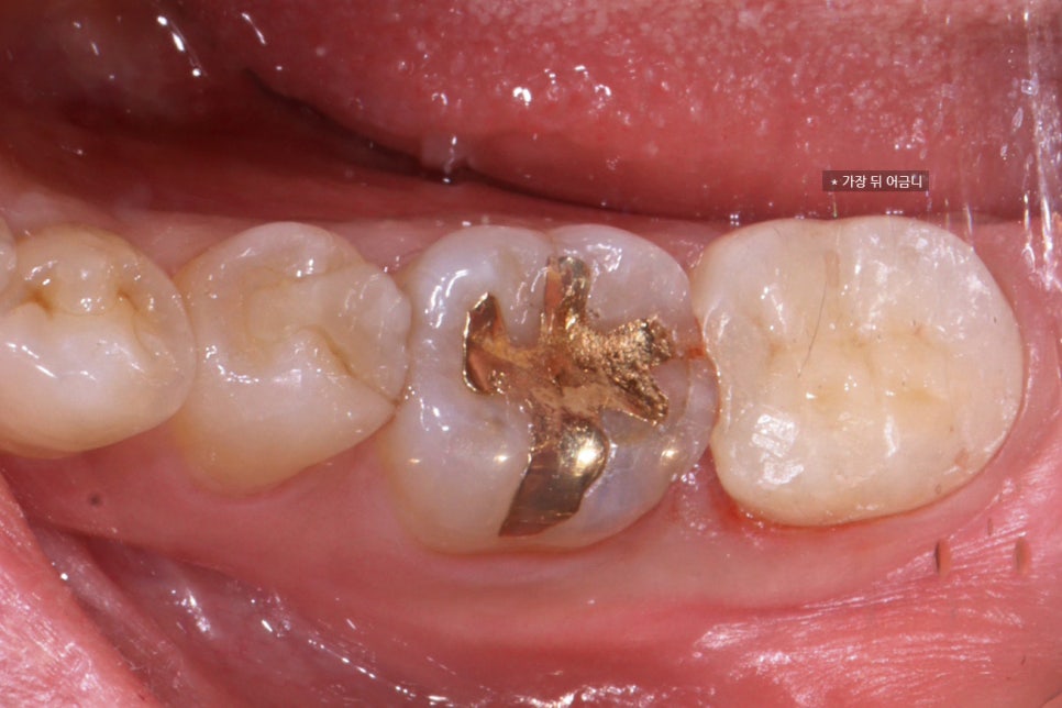 교대역 어금니 크랙 깨짐으로 씹을때 통증, 발치 피하고 신경치료로 유지한 케이스 관련 이미지 9