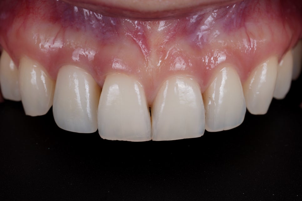 앞니 레진 라미네이트, 1시간 원데이 치료가 가능한 교대 치과 관련 이미지 9