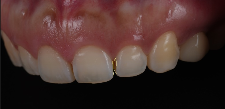 서초구치과 치아 사이 삭제 부작용과 치료법 관련 이미지 9