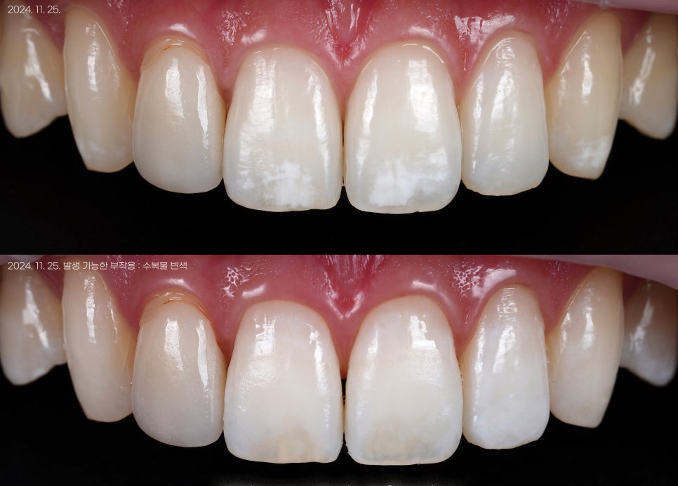 반점치 아이콘 레진, 삭제 없는 최소침습 레진 침투 수복법.review 관련 이미지 4