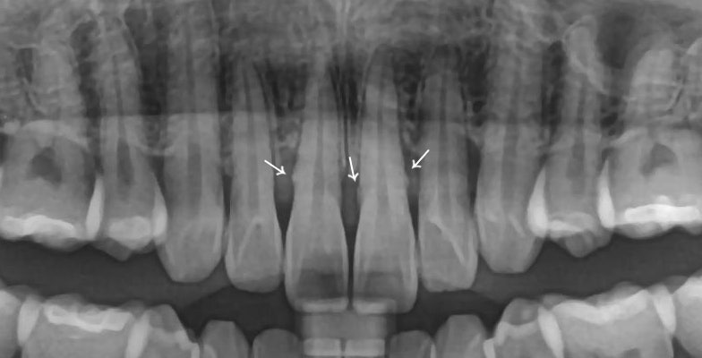블랙 트라이앵글 (블트) 레진으로 건강하게 치료하는 방법 관련 이미지 2