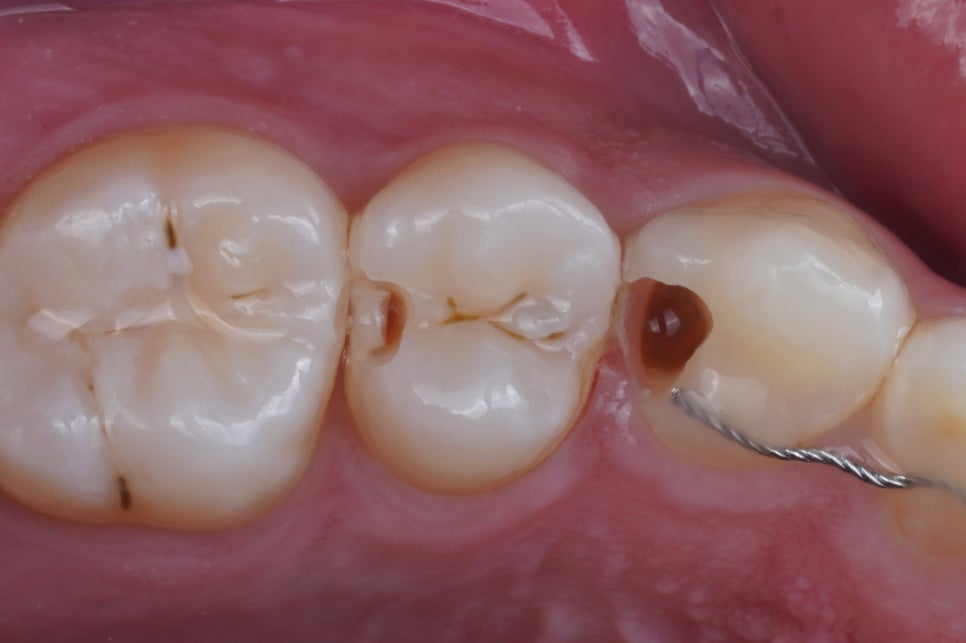 교대역 충치 치과, 신경치료 진단은 보수적으로 접근합니다. 관련 이미지 1