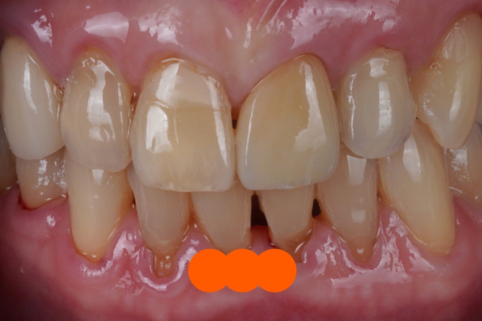 넘어져서 빠질 뻔한 앞니를 신경치료해 지르코니아 크라운으로 살린 케이스 관련 이미지 1