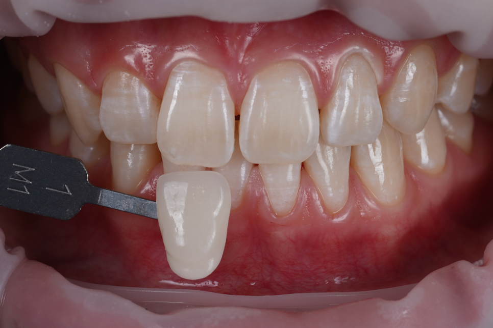 역삼역치과 벌어진 앞니 레진 이렇게 해야 진짜 티 안나요 관련 이미지 14