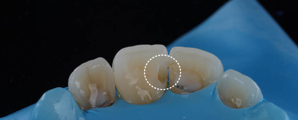 고속터미널역치과 레진치료 처음부터 잘 받아야 하는 이유 관련 이미지 7