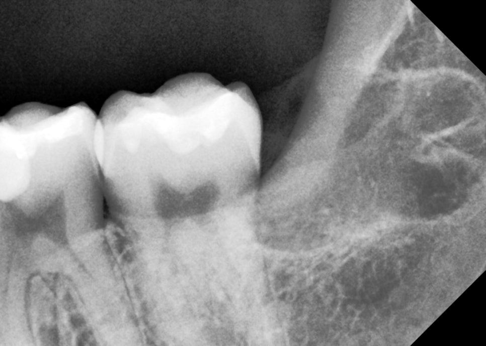 사랑니발치 매복 돼도 이렇게 빼면 안전해요 관련 이미지 10