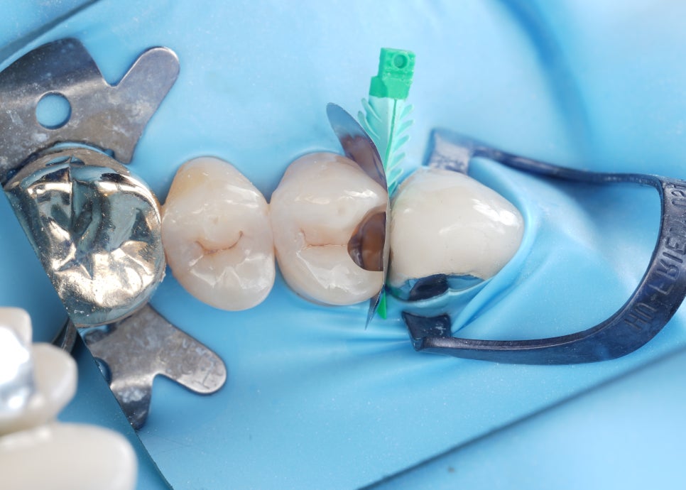 치아 사이 충치를 치료하는 방법, 레진과 인레이 비교 관련 이미지 3