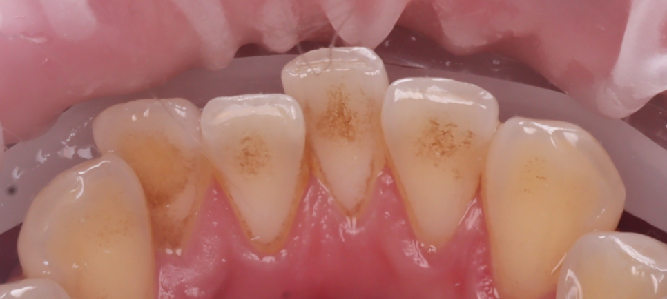 Do Cavities Between Teeth at Sinsa Station Dental Clinic Have to Be Treated with an Inlay? Resin Is Also an Option image 7