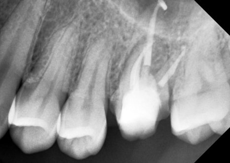 신경치료 후 크라운 씌운 치아 통증, 재신경치료 및 지르코니아 크라운 재치료 관련 이미지 3
