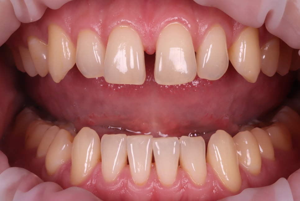 서울치과 앞니 레진 전 이걸 먼저 확인해야 돼요 관련 이미지 4