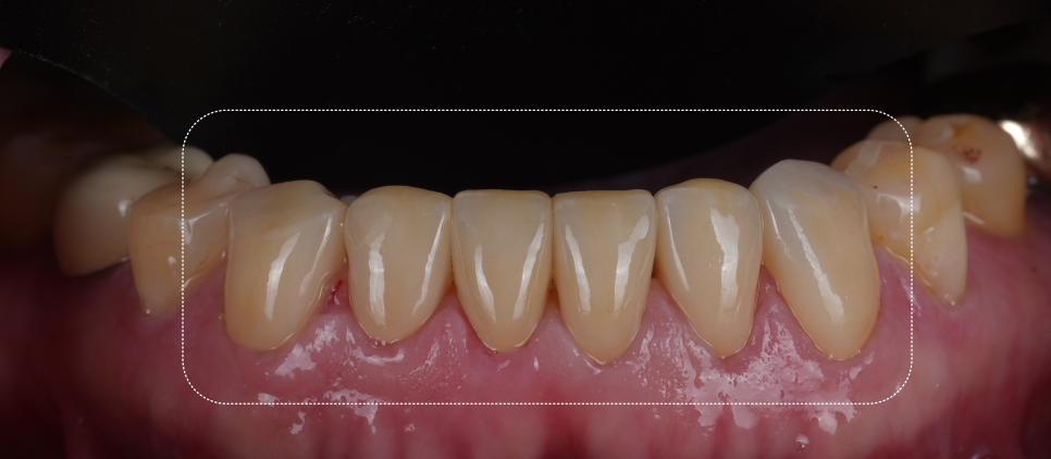 신논현역치과 심하게 마모된 60대 남성 앞니 크라운 치료 관련 이미지 11