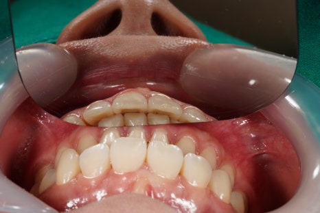 당신이 서울 교대역 재주좋은치과 라미네이트로 치료해야 하는 이유 관련 이미지 5