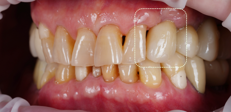 선릉역치과 타원 앞니 임플란트 빼고 재수술 해드린 이유 관련 이미지 10
